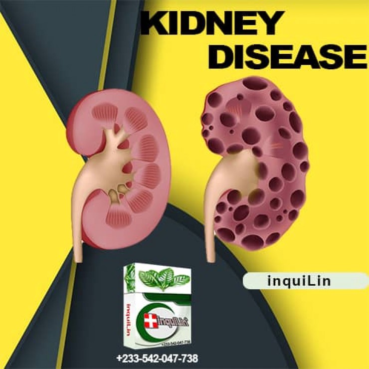 Medicine To Cure Kidney Failure Permanent in Ghana